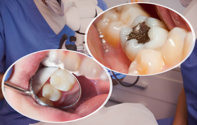 types of tooth cavity fillings