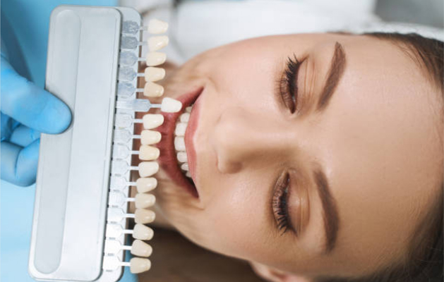 Veneers can be composite or porcelain