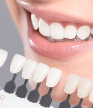 Teeth whitening at Danforth Dental, Cosmetic Dentistry